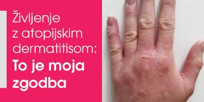 Življenje z atopijskim dermatitisom: 32 letna Sabina nam je zaupala svojo resnično zgodbo